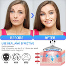 Wrinkle Remover Face Device