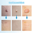 Auto Micro Skin Tag Remover Device